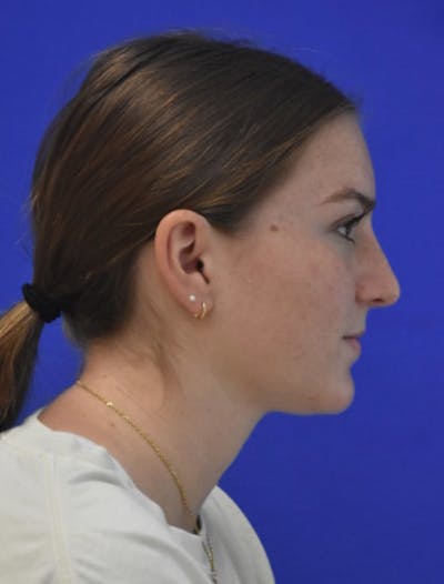 Rhinoplasty Before & After Gallery - Patient 158678 - Image 2