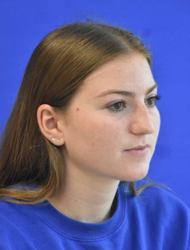 Rhinoplasty Before & After Gallery - Patient 158678 - Image 3