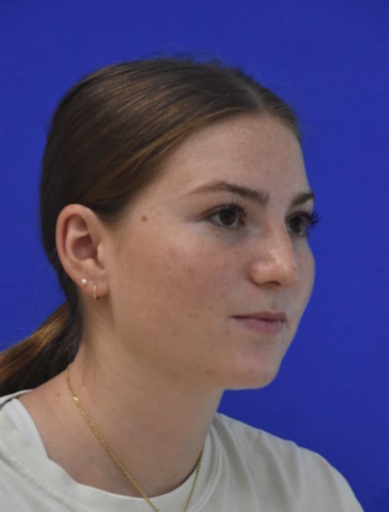 Rhinoplasty Before & After Gallery - Patient 158678 - Image 4