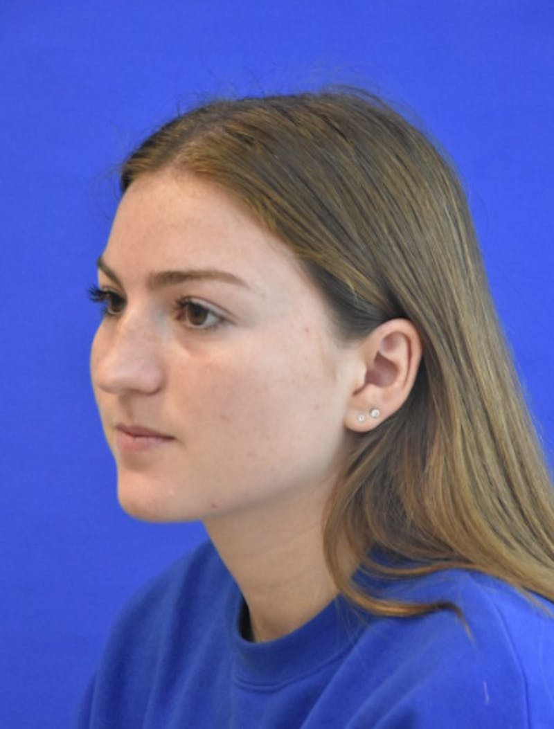 Rhinoplasty Before & After Gallery - Patient 158678 - Image 5