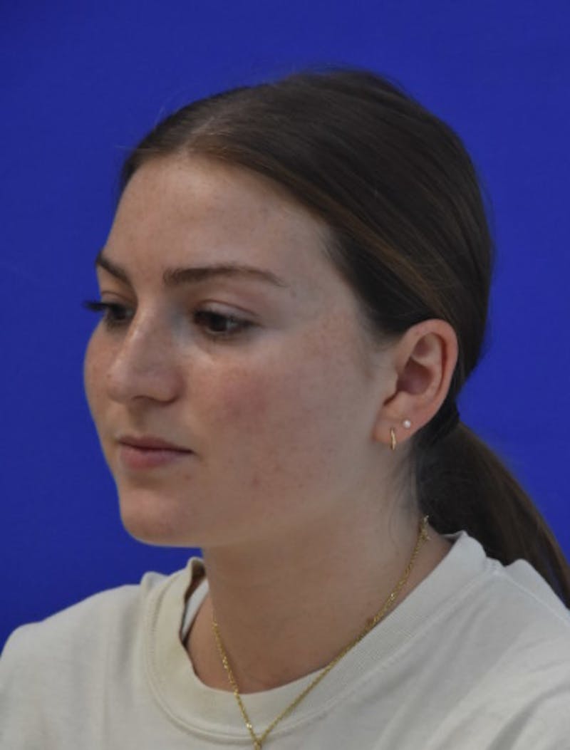 Rhinoplasty Before & After Gallery - Patient 158678 - Image 6