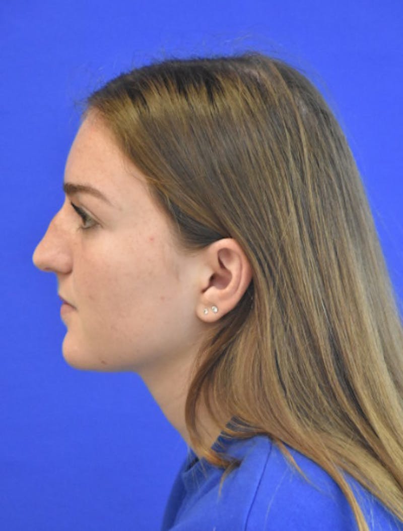 Rhinoplasty Before & After Gallery - Patient 158678 - Image 7
