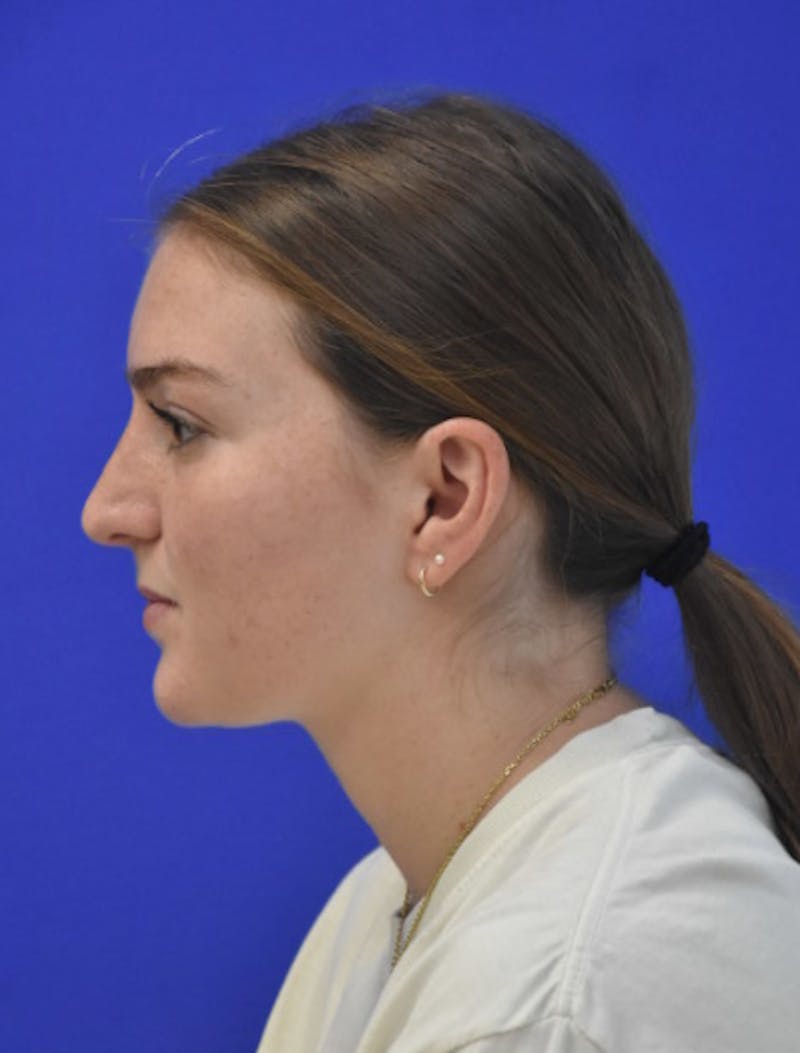 Rhinoplasty Before & After Gallery - Patient 158678 - Image 8
