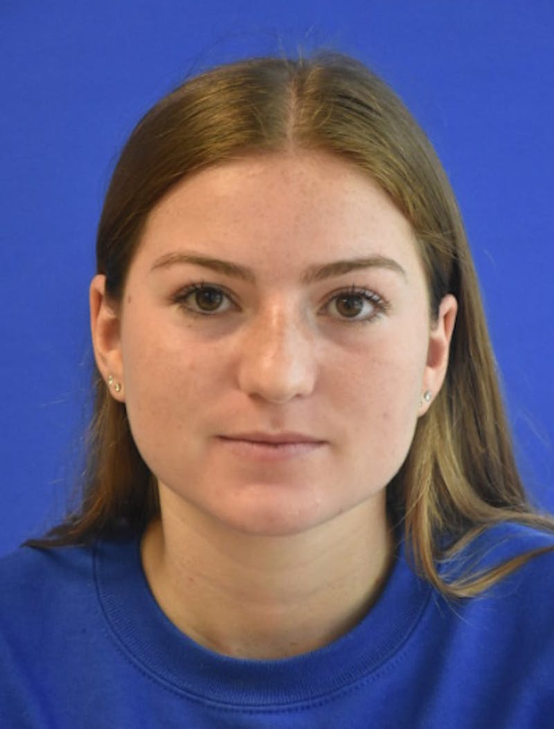 Rhinoplasty Before & After Gallery - Patient 158678 - Image 9