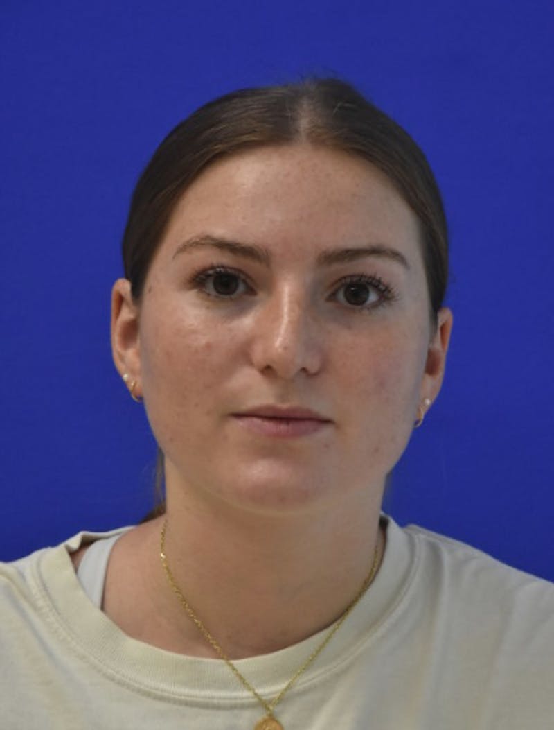 Rhinoplasty Before & After Gallery - Patient 158678 - Image 10