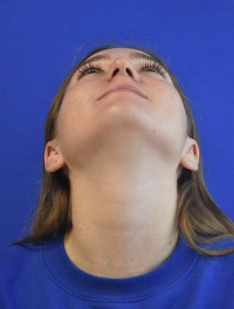 Rhinoplasty Before & After Gallery - Patient 158678 - Image 11