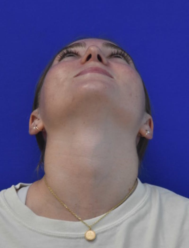 Rhinoplasty Before & After Gallery - Patient 158678 - Image 12