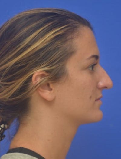 Rhinoplasty Before & After Gallery - Patient 408348 - Image 1