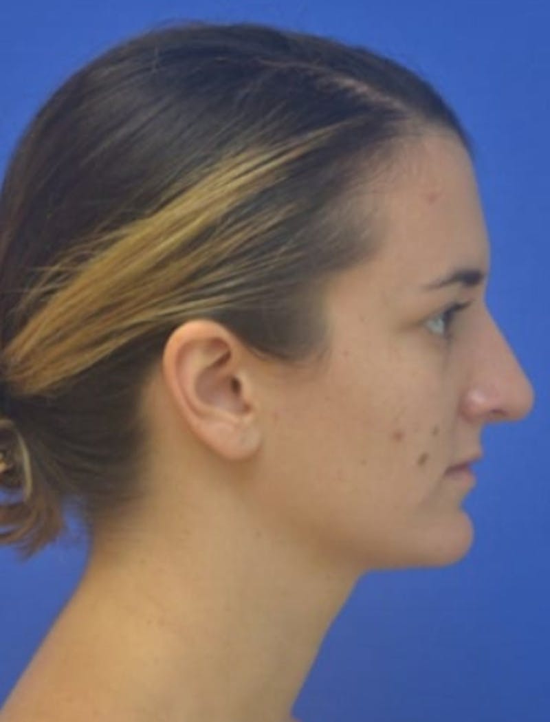 Rhinoplasty Before & After Gallery - Patient 408348 - Image 2