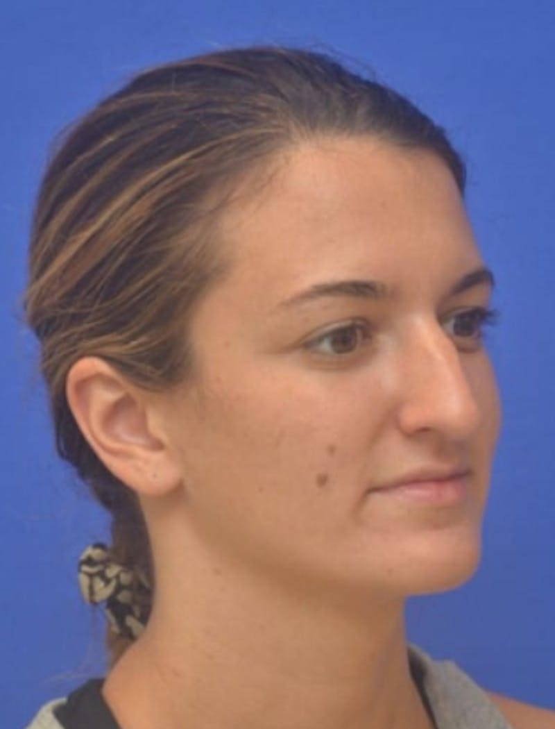 Rhinoplasty Before & After Gallery - Patient 408348 - Image 3