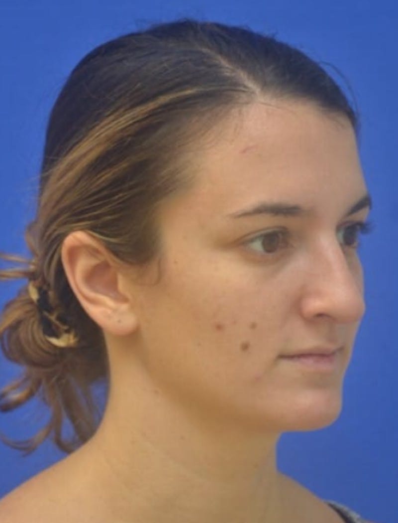 Rhinoplasty Before & After Gallery - Patient 408348 - Image 4