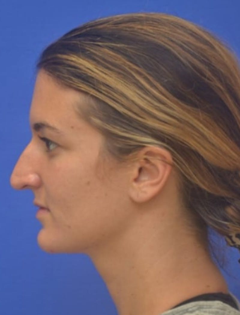 Rhinoplasty Before & After Gallery - Patient 408348 - Image 5