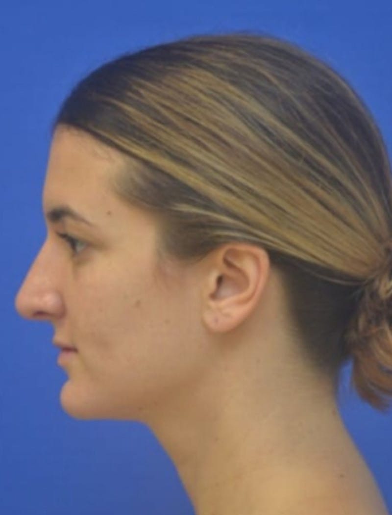 Rhinoplasty Before & After Gallery - Patient 408348 - Image 6