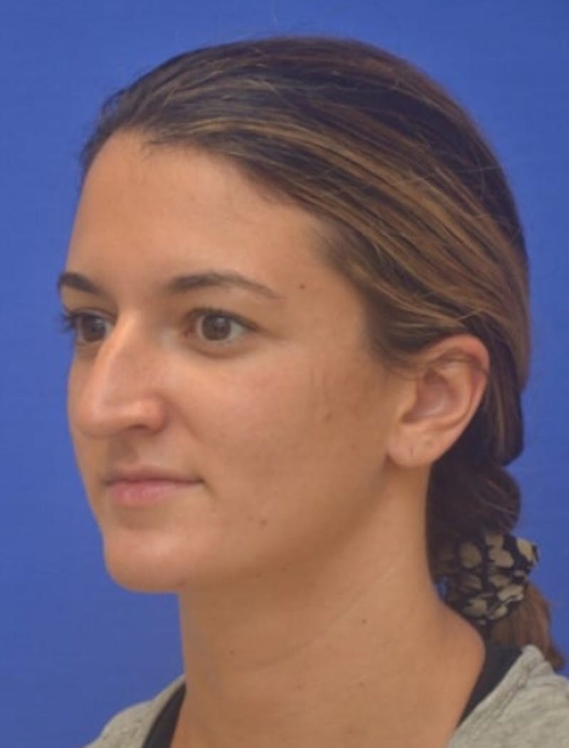 Rhinoplasty Before & After Gallery - Patient 408348 - Image 7
