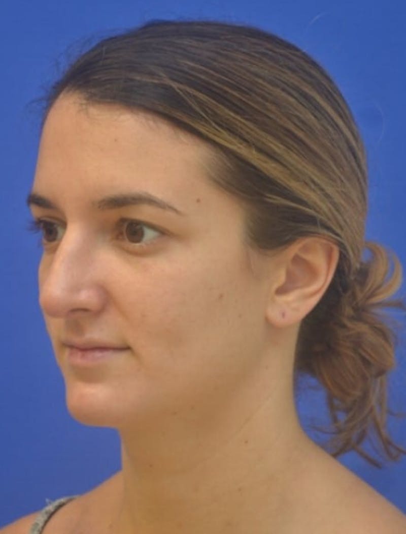 Rhinoplasty Before & After Gallery - Patient 408348 - Image 8