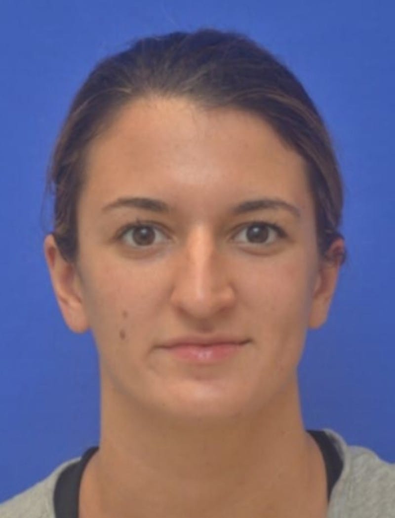 Rhinoplasty Before & After Gallery - Patient 408348 - Image 9