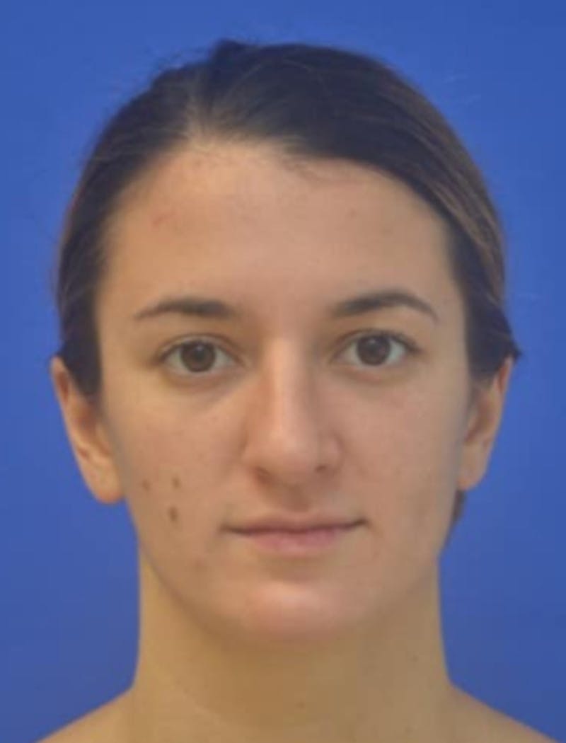 Rhinoplasty Before & After Gallery - Patient 408348 - Image 10