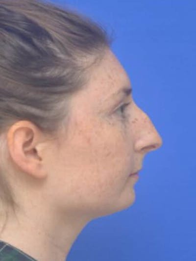 Rhinoplasty Before & After Gallery - Patient 181549 - Image 1