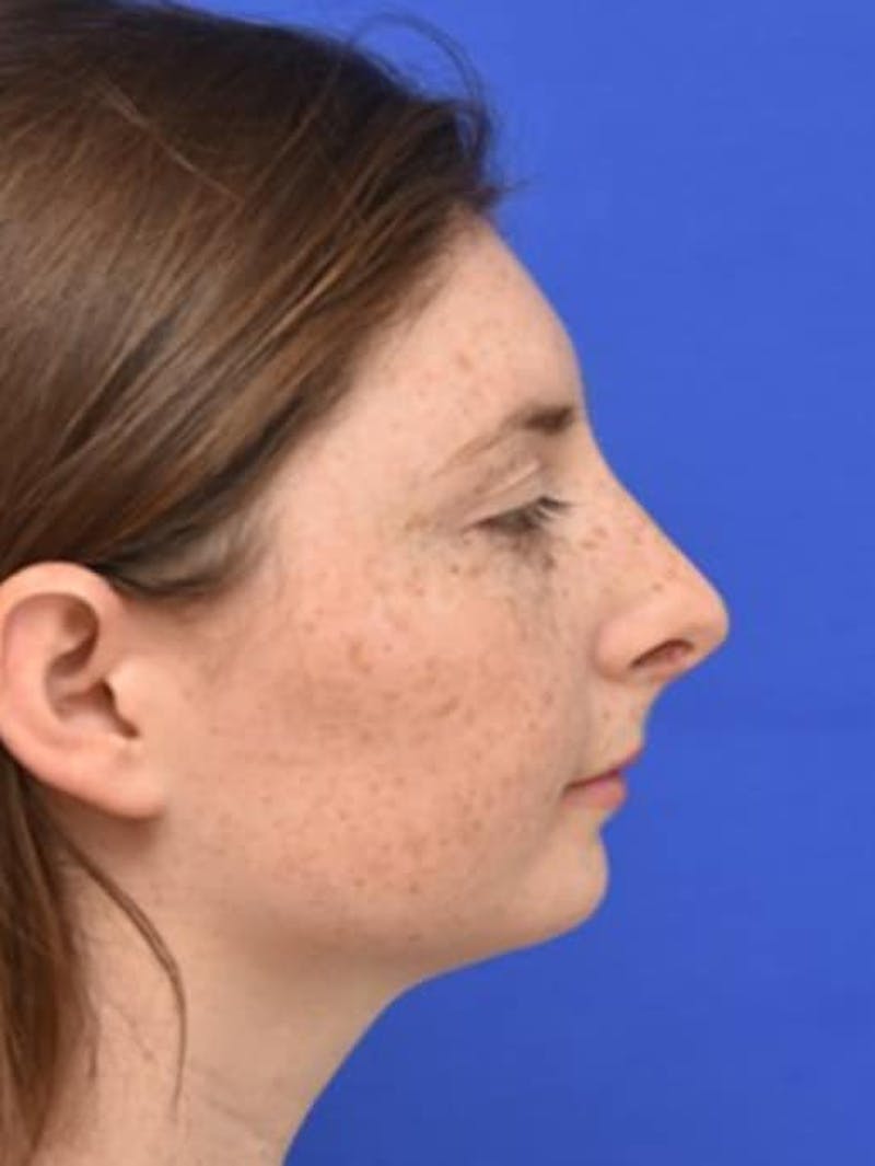Rhinoplasty Before & After Gallery - Patient 181549 - Image 2