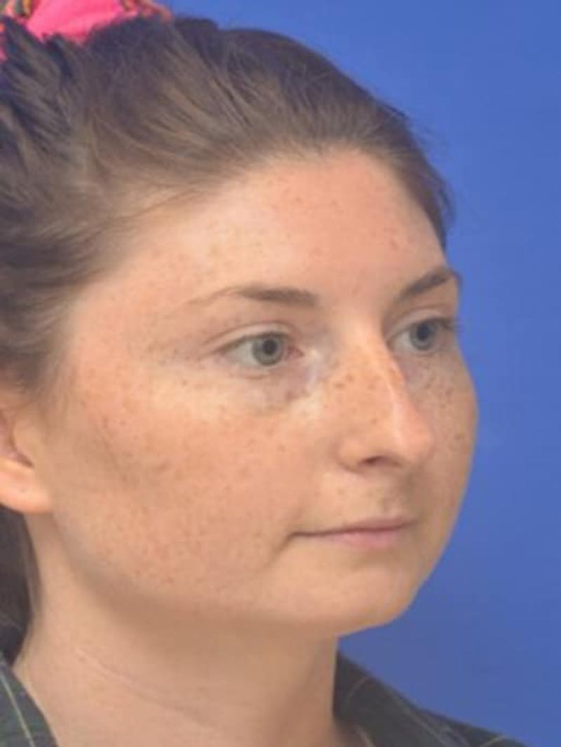 Rhinoplasty Before & After Gallery - Patient 181549 - Image 3