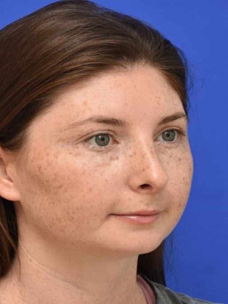 Rhinoplasty Before & After Gallery - Patient 181549 - Image 4