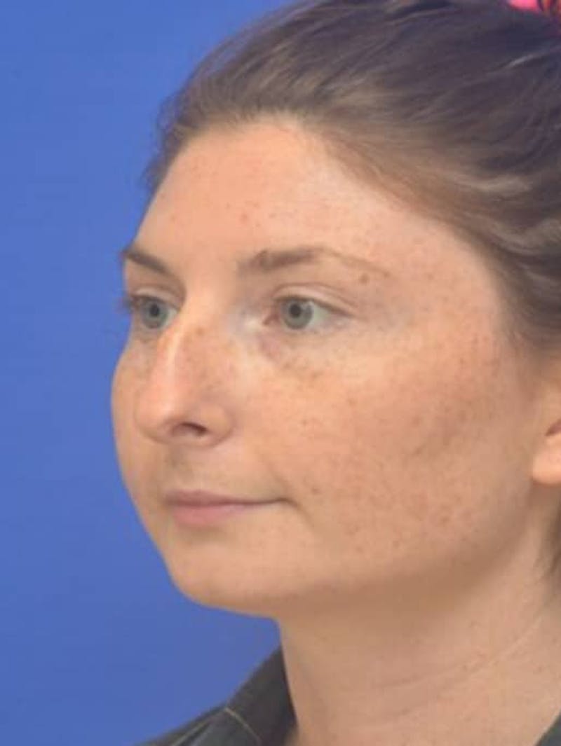 Rhinoplasty Before & After Gallery - Patient 181549 - Image 5