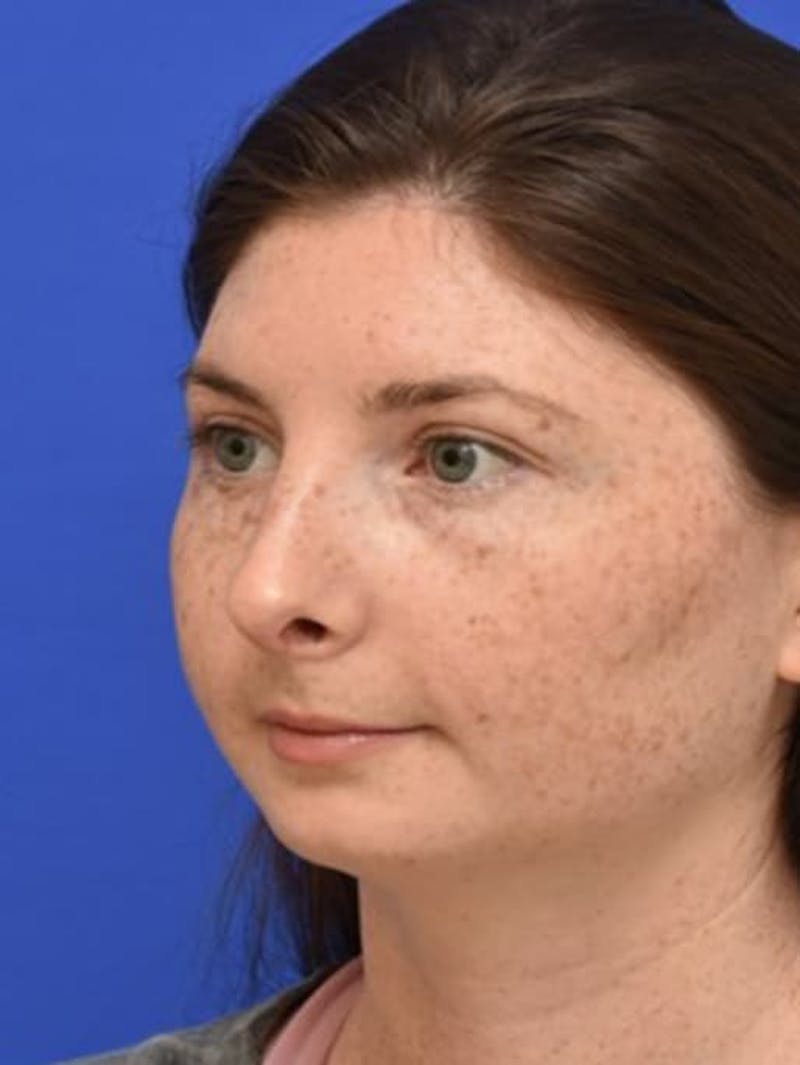 Rhinoplasty Before & After Gallery - Patient 181549 - Image 6