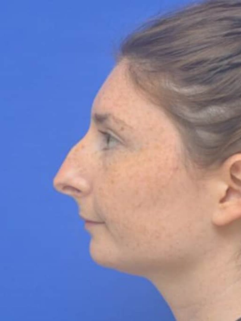 Rhinoplasty Before & After Gallery - Patient 181549 - Image 7