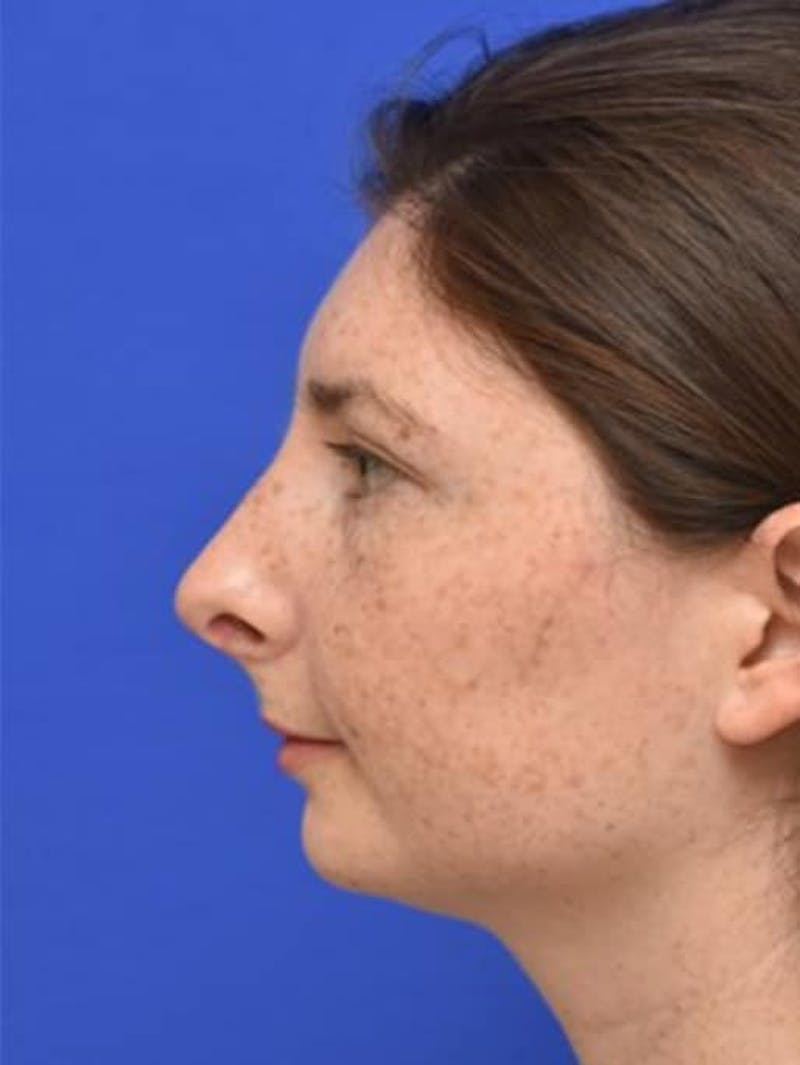 Rhinoplasty Before & After Gallery - Patient 181549 - Image 8