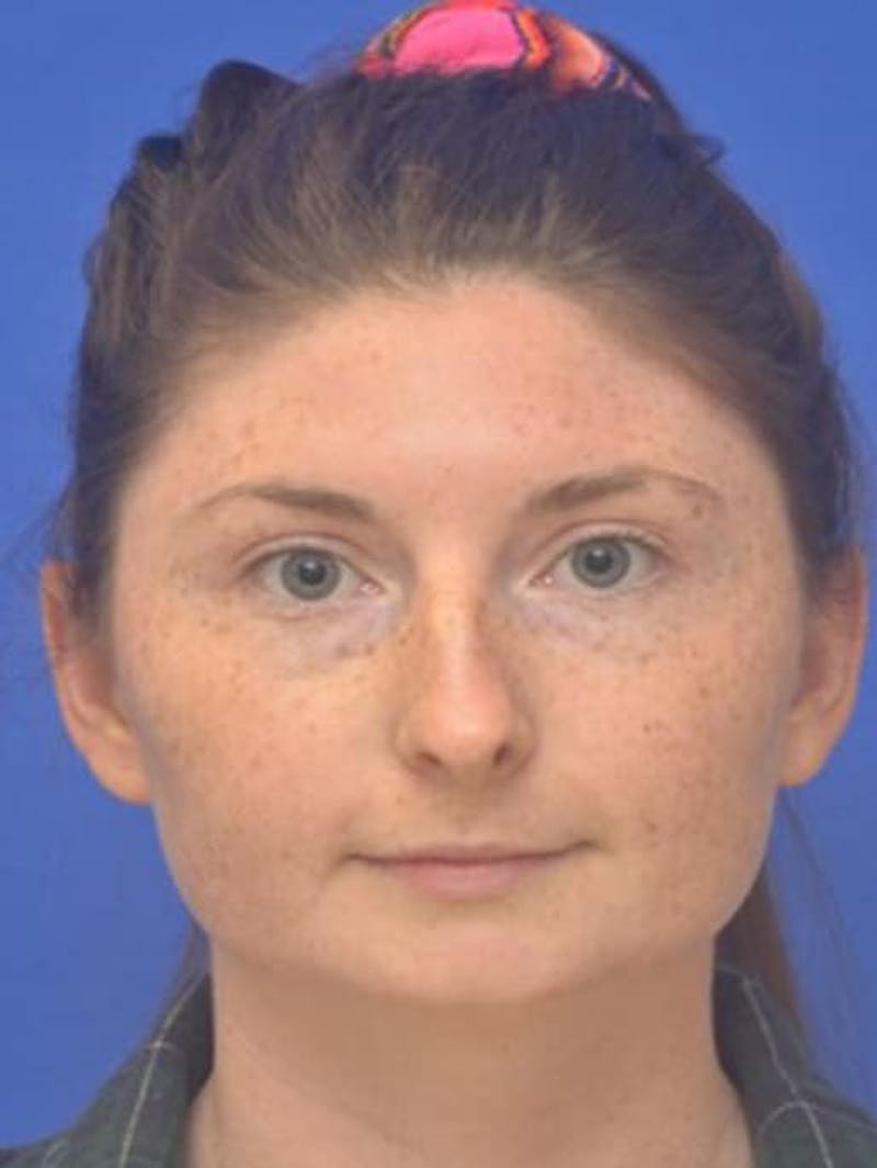 Rhinoplasty Before & After Gallery - Patient 181549 - Image 9
