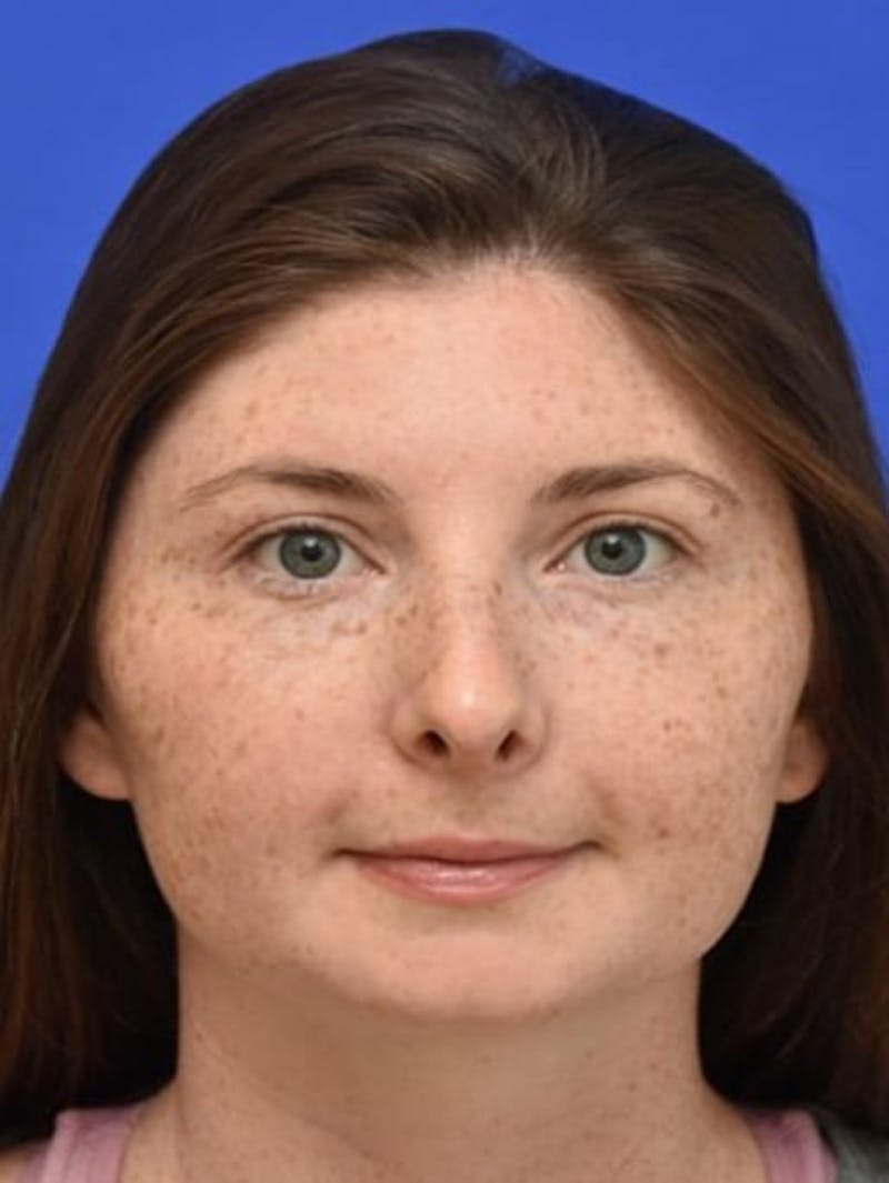 Rhinoplasty Before & After Gallery - Patient 181549 - Image 10