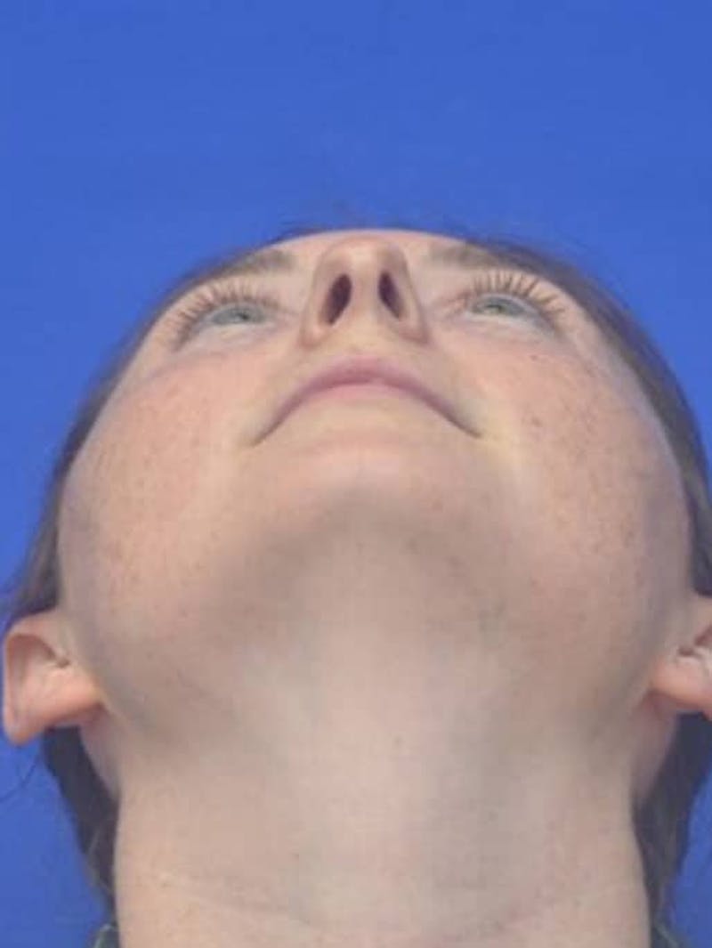 Rhinoplasty Before & After Gallery - Patient 181549 - Image 11