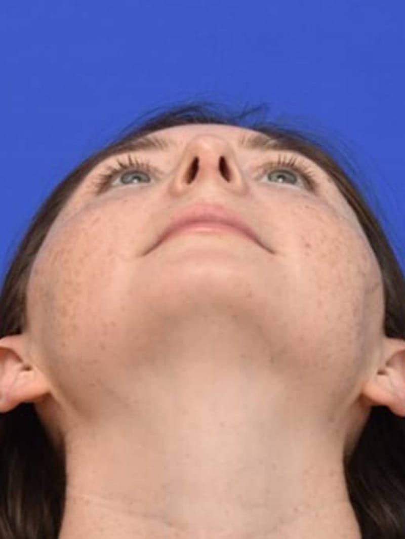 Rhinoplasty Before & After Gallery - Patient 181549 - Image 12