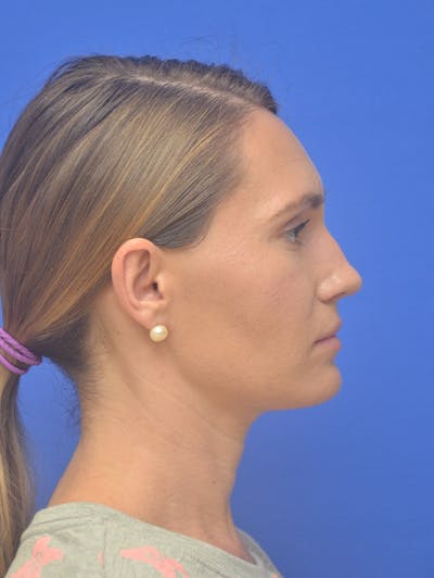 Rhinoplasty Before & After Gallery - Patient 275787 - Image 1