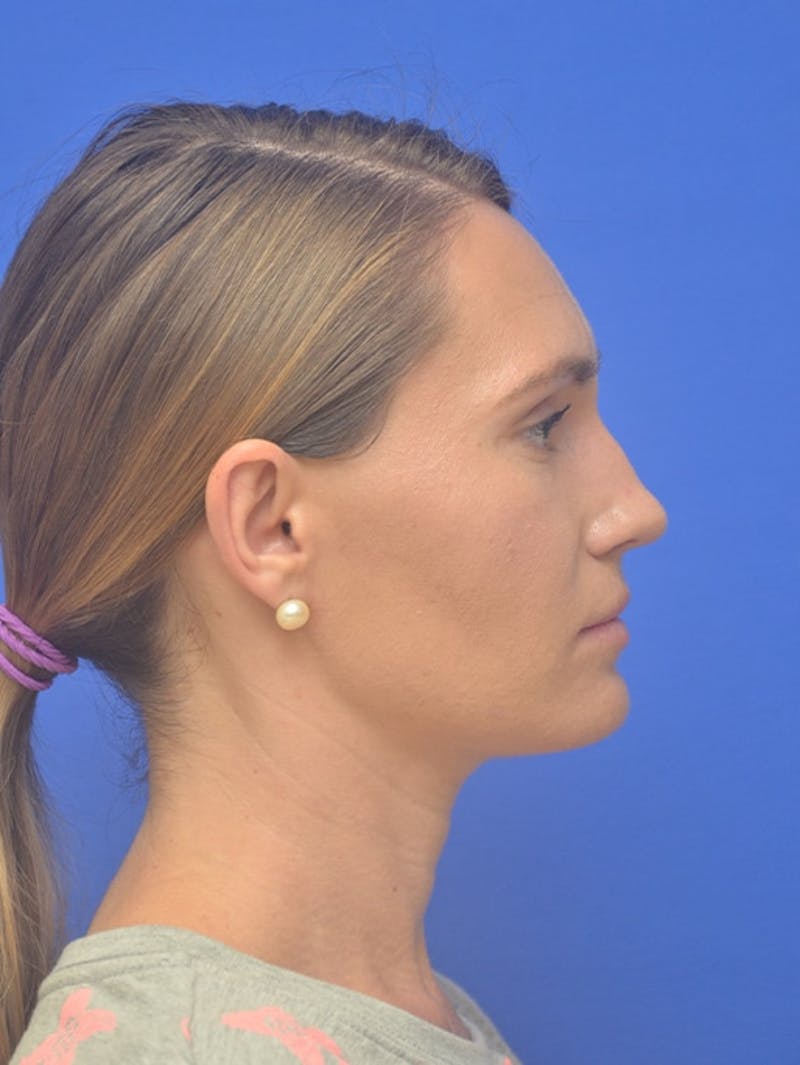 Rhinoplasty Before & After Gallery - Patient 275787 - Image 1