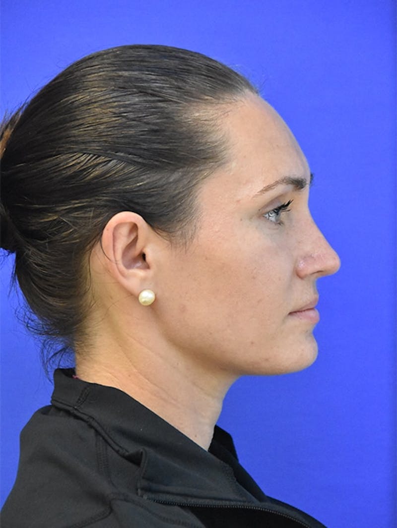 Rhinoplasty Before & After Gallery - Patient 275787 - Image 2