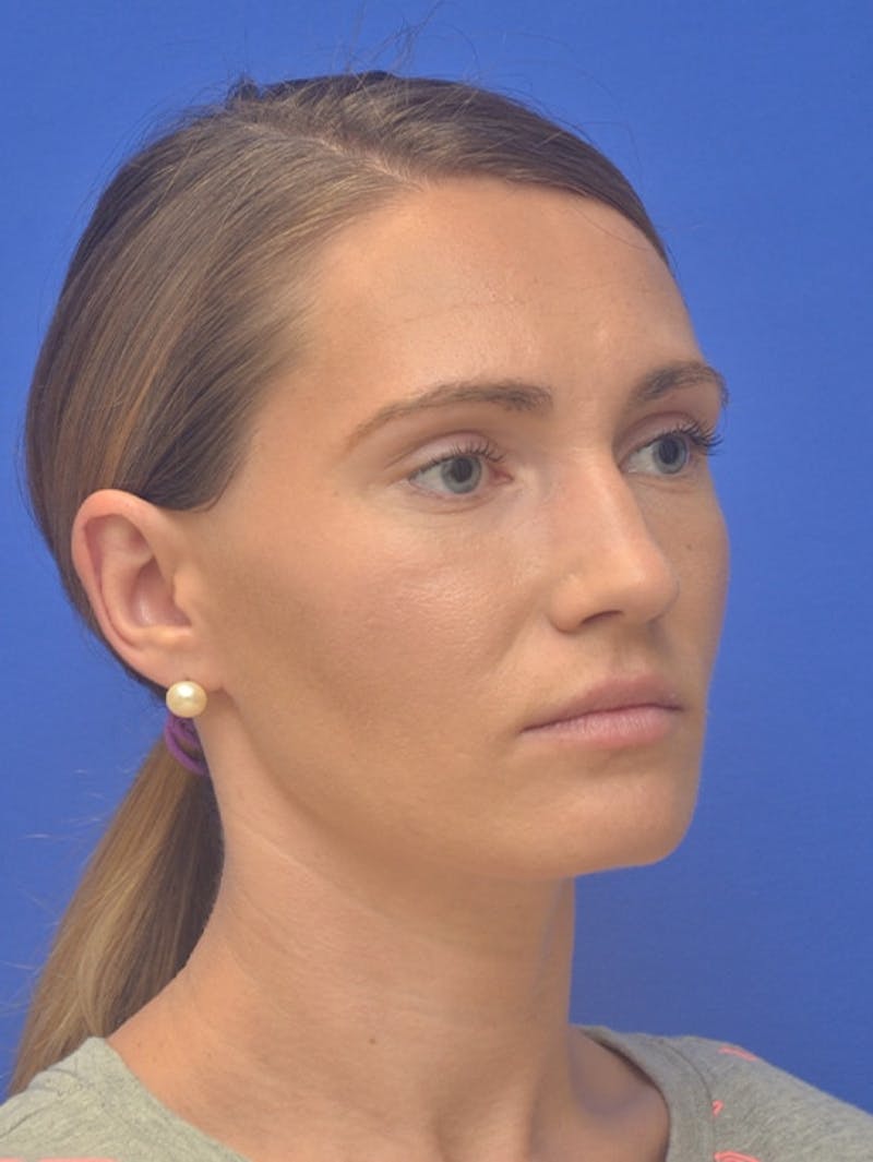 Rhinoplasty Before & After Gallery - Patient 275787 - Image 3