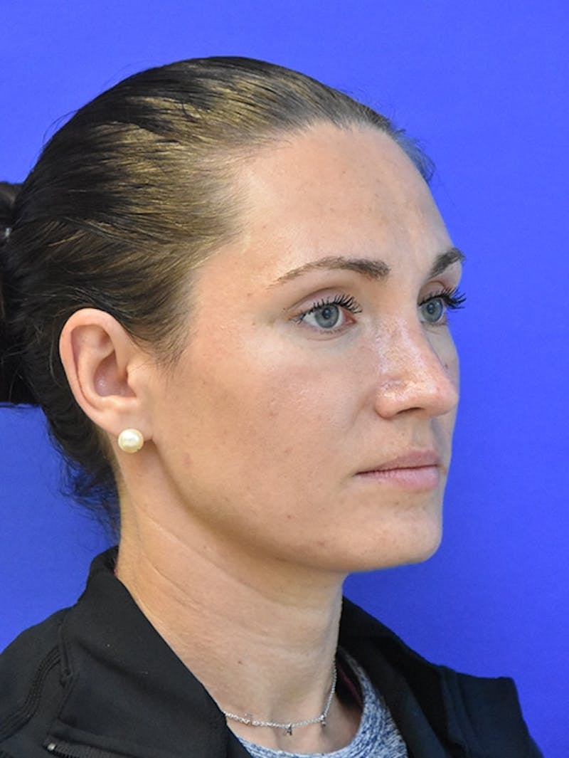 Rhinoplasty Before & After Gallery - Patient 275787 - Image 4