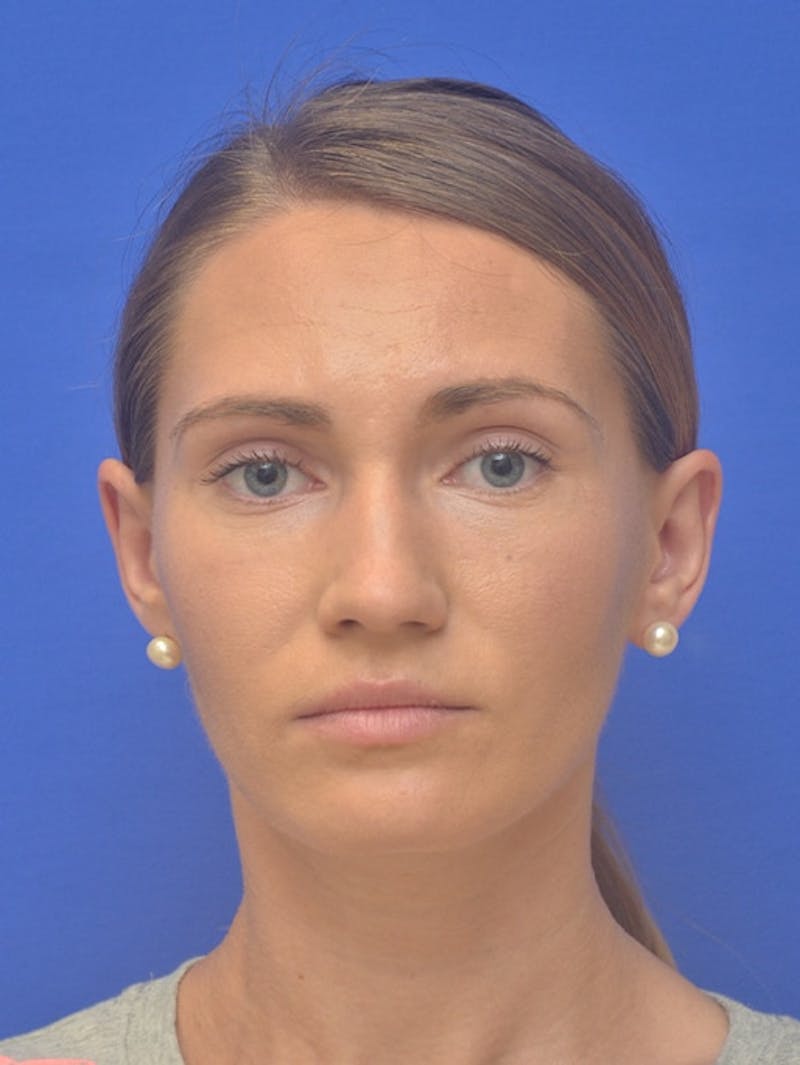 Rhinoplasty Before & After Gallery - Patient 275787 - Image 5