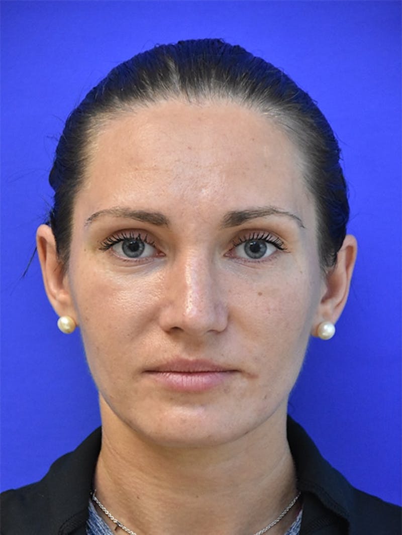 Rhinoplasty Before & After Gallery - Patient 275787 - Image 6