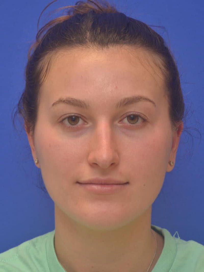Rhinoplasty Before & After Gallery - Patient 130714 - Image 1