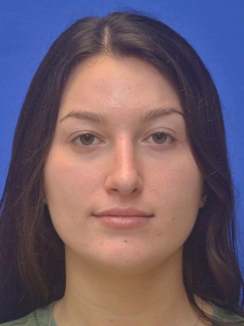 Rhinoplasty Before & After Gallery - Patient 130714 - Image 2
