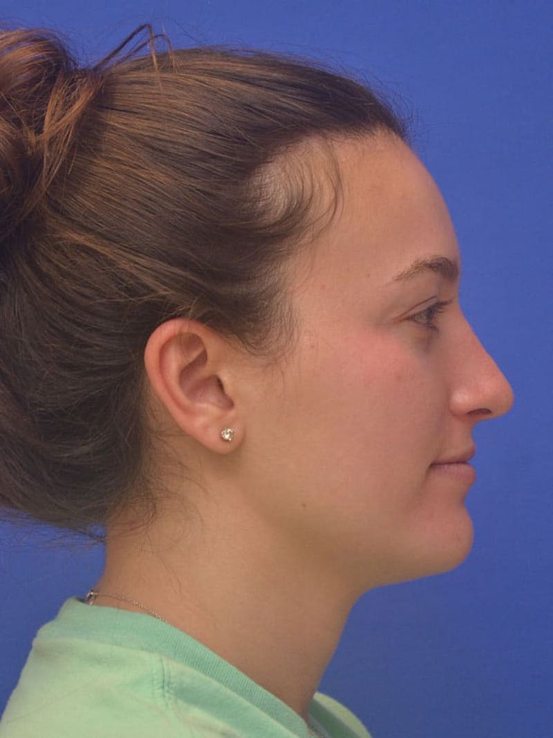 Rhinoplasty Before & After Gallery - Patient 130714 - Image 3