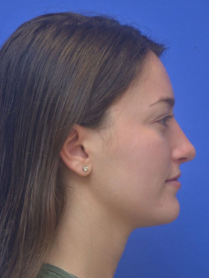 Rhinoplasty Before & After Gallery - Patient 130714 - Image 4