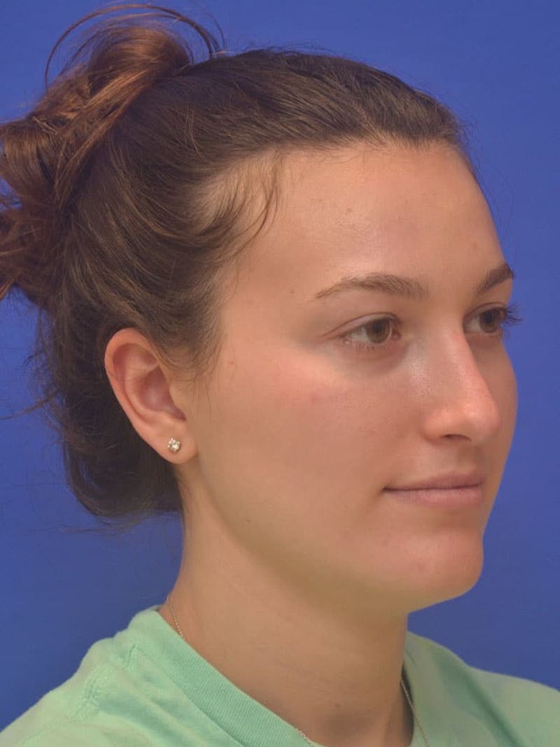 Rhinoplasty Before & After Gallery - Patient 130714 - Image 5