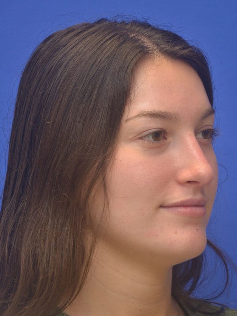 Rhinoplasty Before & After Gallery - Patient 130714 - Image 6