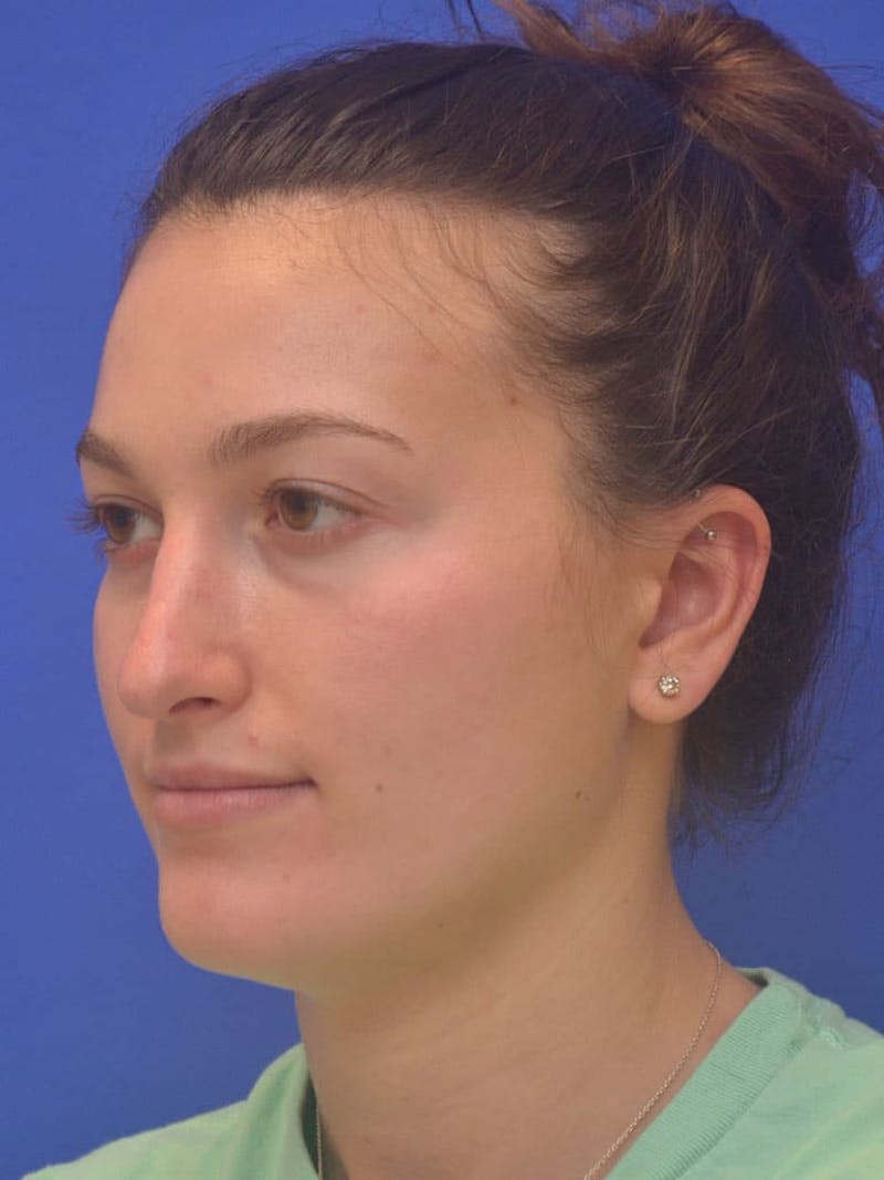 Rhinoplasty Before & After Gallery - Patient 130714 - Image 7