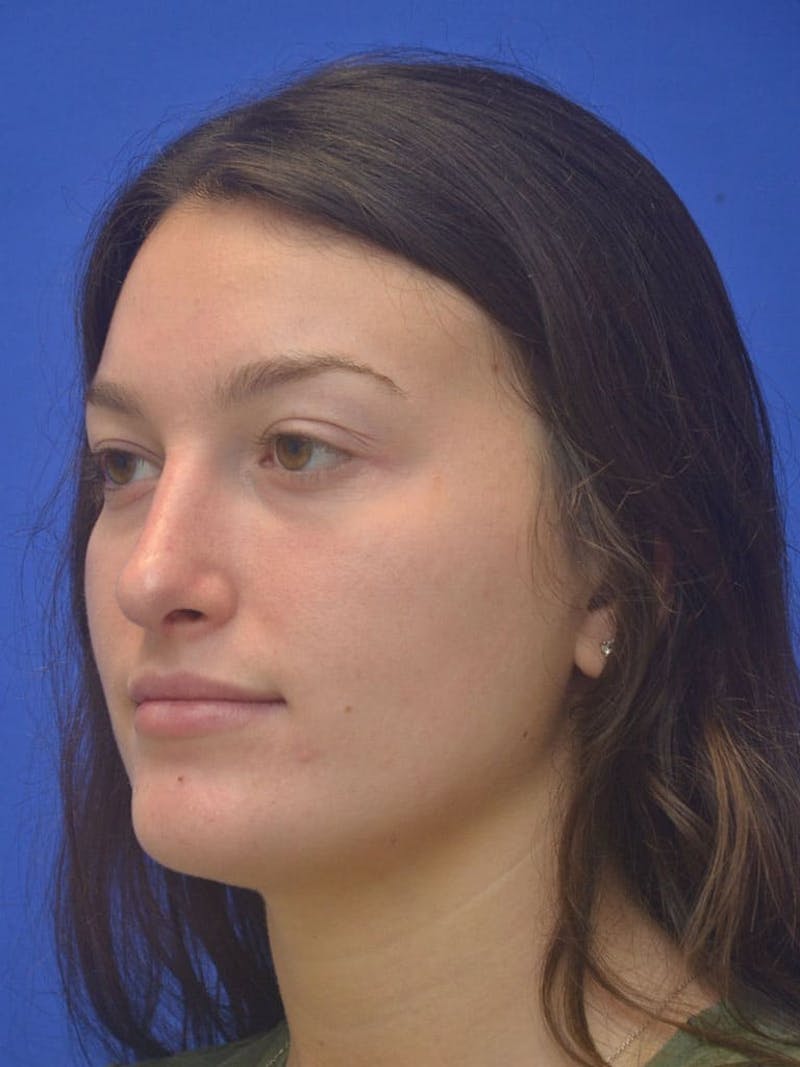 Rhinoplasty Before & After Gallery - Patient 130714 - Image 8