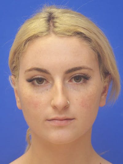 Rhinoplasty Before & After Gallery - Patient 113586 - Image 1