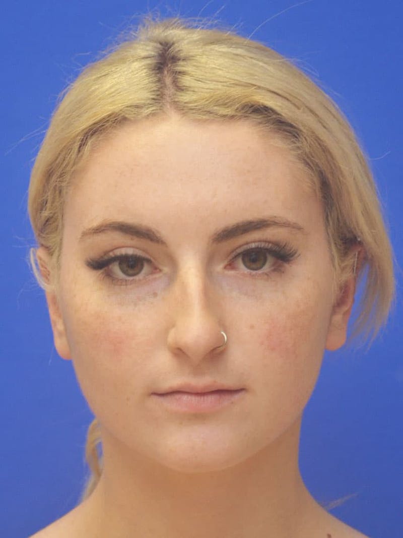 Rhinoplasty Before & After Gallery - Patient 113586 - Image 1